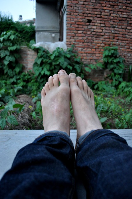My feet, featuring my Lisfranc Injury scar